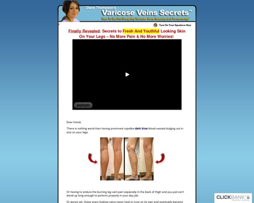 Varicose Veins Natural Alternative Home Remedies, Herbal & Treatment Help – Spider Veins Cure Ways